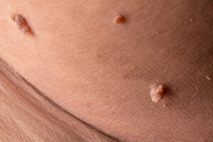 Skin Tag